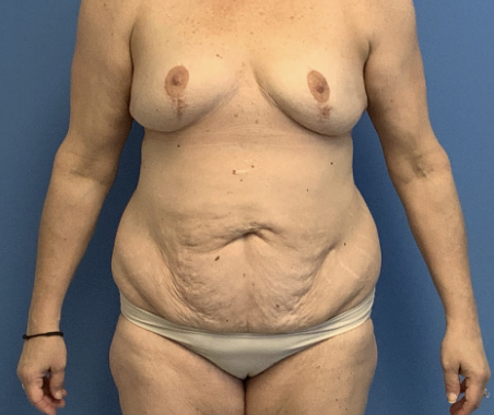 Tummy-Tuck-with-Liposuction--Case-Study-8642 | Before Liposuction